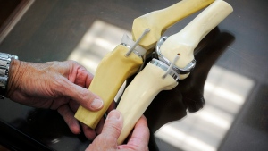 Saskatchewan still holds longest wait times in Canada for knee, hip replacements