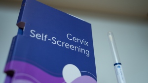 Outdated cancer screening guidelines jeopardizing early detection, doctors say