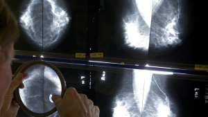 Breast cancer screening should start at age 40, Canadian Cancer Society says