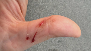 'He was trying to bite my thumb off:' Vancouver woman says she was attacked in Stanley Park