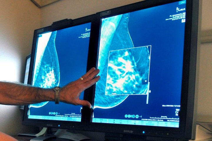 Breast cancer is rising among U.S. young women even as deaths drop: study