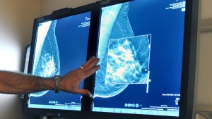 Ontario lowers the age for regular mammogram breast screening to age 40