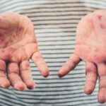 More measles exposures reported in Winnipeg