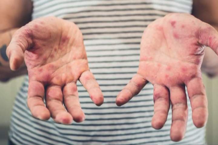 More measles exposures reported in Winnipeg