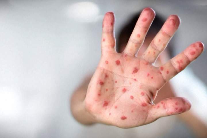 Alberta health experts warn of possible measles resurgence as kids head back to school