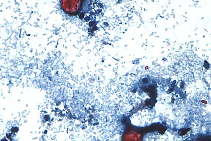 Where cyclosporiasis cases stand in Canada as U.S. parasite outbreak rages